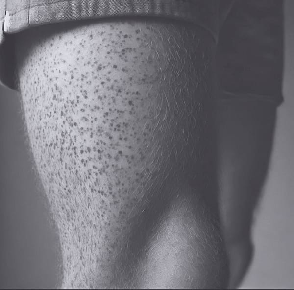 I don’t like your freckles